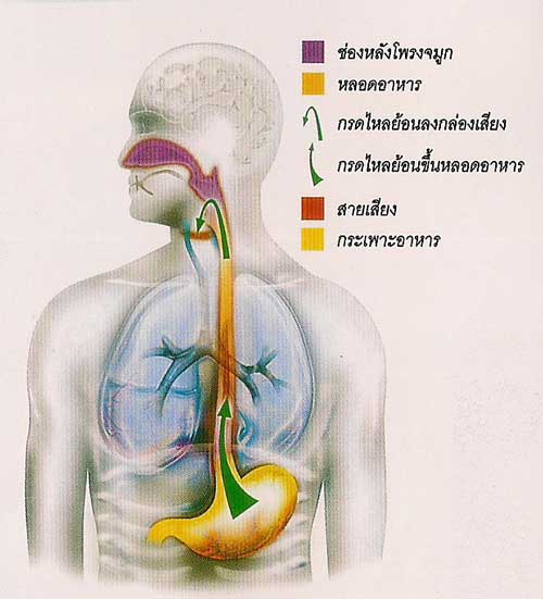 โรคกรดไหลย้อนจากกระเพาะสู่หลอดอาหาร (GERD)