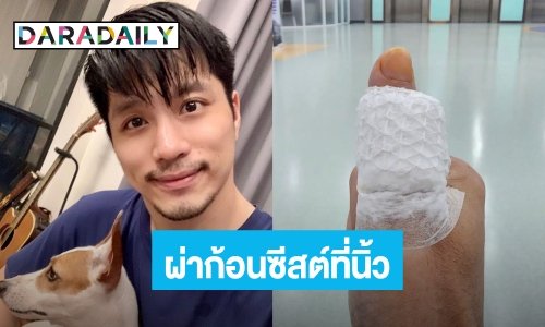 “ตี๋ วิวิศน์” แชร์ประสบการณ์ ผ่าก้อนซีสต์ขึ้นที่นิ้วโป้งมา 3 ปี