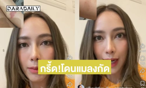 กรี้ด!! ดาราดังโดนแมลงนี้กัดจนเป็นรอยไหม้ 