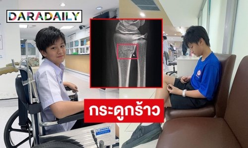 เจ็บแต่ต้นปี “อั่งเปา ธัณญ์กรณ์” กระดูกร้าวจากอุบัติเหตุระหว่างเล่นบาสเก็ตบอล