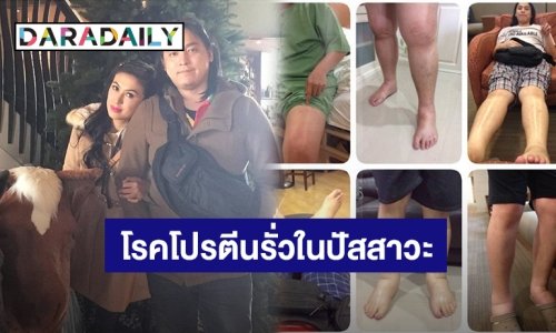 “ตุ๊กตา อุบลวรรณ” เล่าแฟนป่วยเป็นโรคโปรตีนรั่วในปัสสาวะ ขาบวมน้ำหนักขึ้นเกือบ100โล