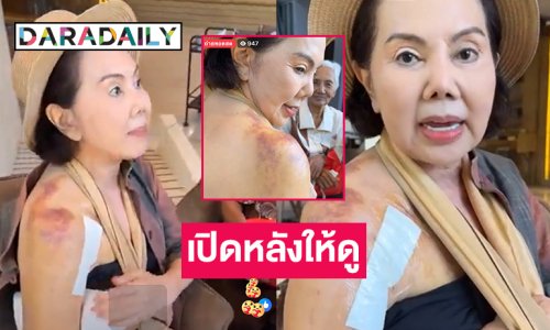 นักแสดงรุ่นใหญ่เล่าวินาทีล้มกระดูกแขนขวาหักเปิดหลังให้ดู...โอ้ช้ำสีเขียวเหลือง