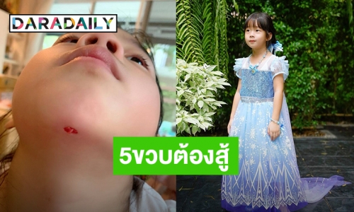 5ขวบต้องสู้! “น้องเป่าเปา” ล้มคางแตกเย็บ 4 เข็มฟาดเคราะห์ก่อนวันเกิด