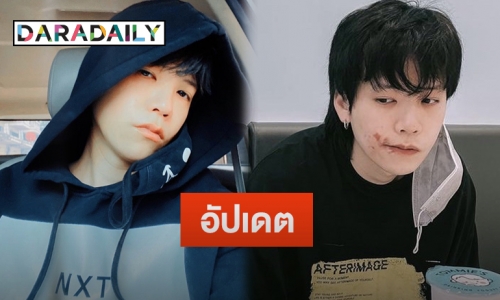 “คชา นนทนันท์” อัปเดตหลังโดนพิษแมลงก้นกระดก ทำผื่นขึ้นใบหน้า