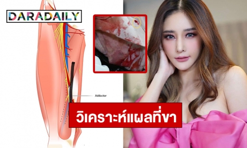 วิเคราะห์แผลที่ขา “แตงโม” จากแพทย์ 