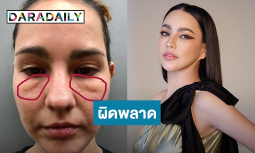 “แหม่ม วิชุดา”แชร์ประสบการณ์ฉีดไขมันใต้ตาแล้วเกิดข้อผิดพลาด