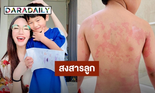 “อ๋อม” โอดสงสาร “น้องจอมทัพ” ผื่นแดงขึ้นเต็มตัวไม่รู้แพ้อะไร