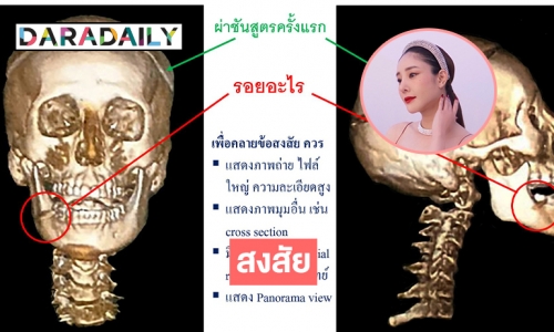 หมอธวัชชัยสงสัยกรามข้างขวาของ “แตงโม นิดา”