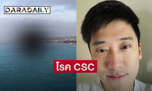 โรค CSC  รุม “เต้ วิทย์สรัช” ดวงตามองเห็นแบบนี้