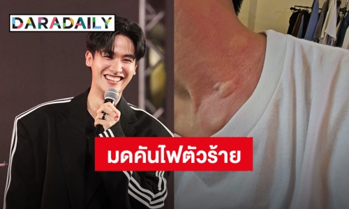 “เต ตะวัน” โดนมดคันไฟกัดคอแดงเป็นผื่นใหญ่ แฟนคลับส่งความเป็นห่วงเพียบ