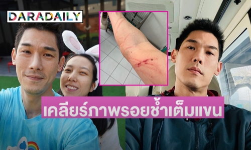 “กันต์ กันตถาวร” รีบแจงด่วนหลังโพสต์ภาพแขนมีรอยขีดข่วนเต็มไปหมด ตอบแล้วใครเป็นคนทำ!