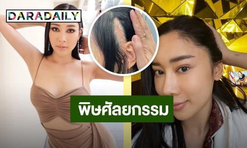 สุดช้ำใจ! “น้ำเพชร” ศัลยกรรมทำพิษ เตือนแฟนคลับให้คิดดีๆ ก่อนทำ