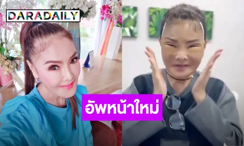 “ดาว มยุรีย์” เผยหน้าสดผ่าตัดดึงหน้า ลดอายุ ครบ 3 วัน