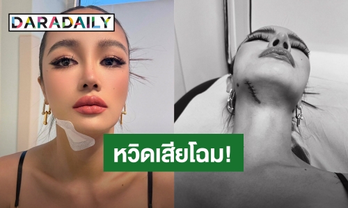 หวิดเสียโฉม! “กระแต อาร์สยาม” ฟาดเคราะห์แรง ลื่นล้มคางแตกเย็บ 5 เข็ม