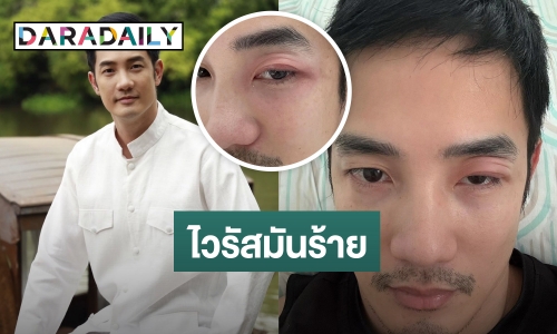 เจอกับตัว! “อ้วน รังสิต” โดนไวรัสตัวร้ายทำพิษจนตาบวม