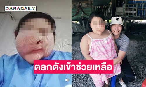 ตลกดังเข้าช่วยเหลือเด็กหญิงใบหน้าผิดรูปเข้ารับการผ่าตัด