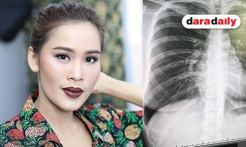 งานเข้า “หนูเล็ก ก่าก๊า” ไม่กินยาจนปอดแหว่ง