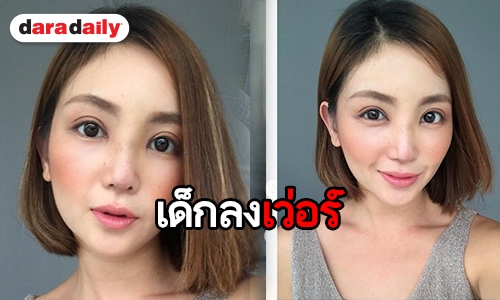 ตา-จมูกใหม่ไฉไลกว่าเก่า “ฮารุ” นับวันรอหายบวม