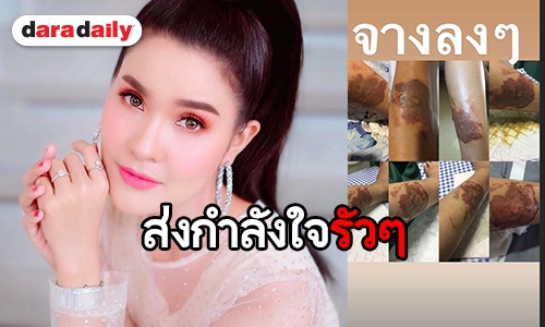 “เปา เปาวลี” อัพเดทบาดแผลล่าสุด หลังประสบเหตุถูกน้ำมันราดที่ขา