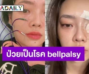 ปีนี้เอาเรื่องสุด! “พรอยมน” โพสต์เล่าละเอียดป่วยเป็นโรค bellpalsy 