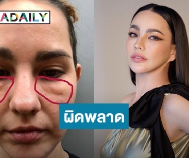 “แหม่ม วิชุดา”แชร์ประสบการณ์ฉีดไขมันใต้ตาแล้วเกิดข้อผิดพลาด