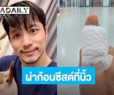  “ตี๋ วิวิศน์” แชร์ประสบการณ์ ผ่าก้อนซีสต์ขึ้นที่นิ้วโป้งมา 3 ปี