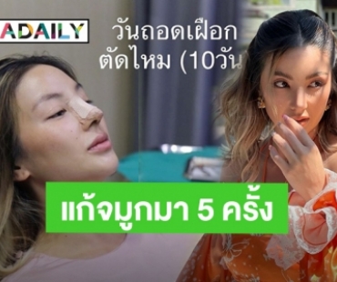 “ฮารุ สุประกอบ” แก้จมูกใหม่รอบที่ 5 พอหน้าเข้าที่แล้วสวยพุ่งมากแม่