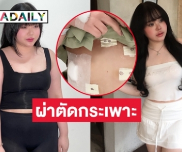 “เน็ตไอดอล”  รีวิวพลีชีพผ่าตัดกระเพาะ จาก 86 เหลือ 68 ในสามเดือน 