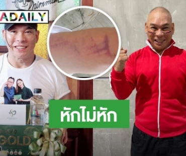 “โหน่ง ชะชะช่า” โชว์แผลรอยแดงช้ำ ลุ้น! หักไม่หัก