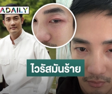 เจอกับตัว! “อ้วน รังสิต” โดนไวรัสตัวร้ายทำพิษจนตาบวม