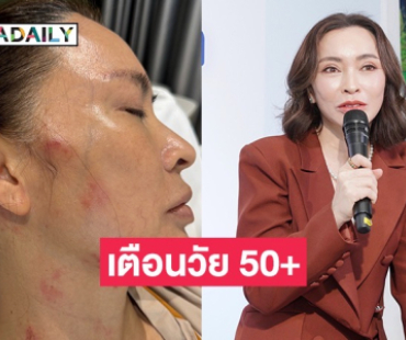 “ปุ้ย พิมลวรรณ” แชร์ประสบการณ์หลังเป็นโรคงูสวัด เตือนวัย 50+ อันตรายกว่าที่คิด! 