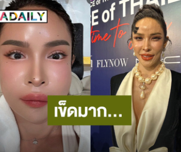 “นัท นิสามณี” รับเข็ด! ฉีดหน้าหมอกระเป๋า ปากบนชา 3 เดือนพูดได้ปกติ