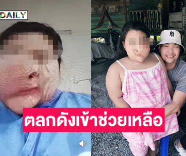 ตลกดังเข้าช่วยเหลือเด็กหญิงใบหน้าผิดรูปเข้ารับการผ่าตัด