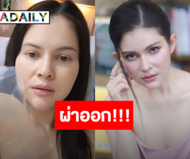 “แอนนี่ บรู๊ค” ผ่าตัดถอดซิลิโคนหน้าอกเก่าออก หลังอยู่มา 20 ปี